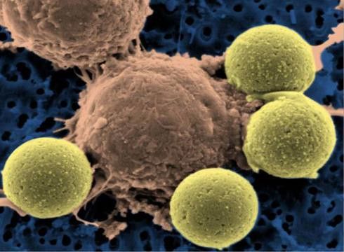 Leukemia treatment - immune system T-cells (center) binding to beads which cause the cells to divide