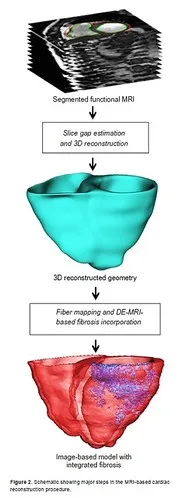 Figure 2 from Effects of Fibrosis Morphology on Reentrant Ventricular Tachycardia Inducibility and Simulation Fidelity in Patient-Derived Models published in Clinical Medicine Insights: Cardiology