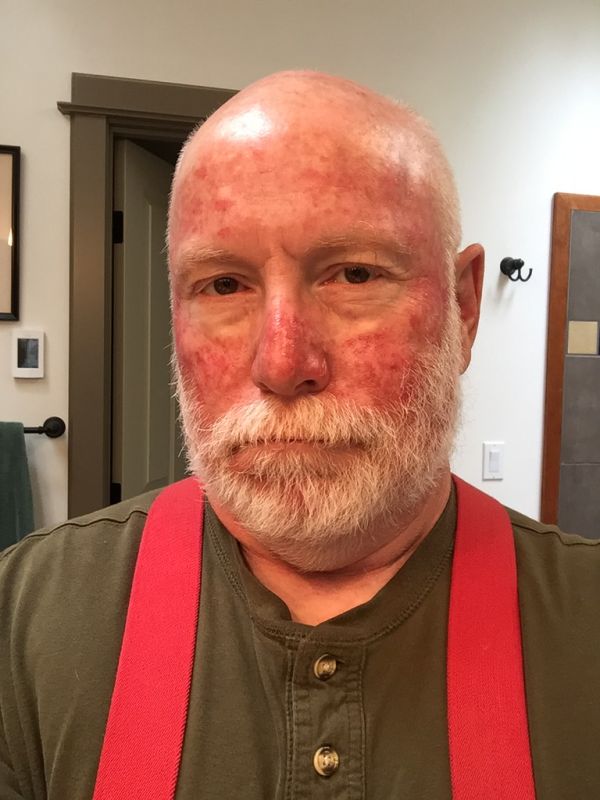 Skin cancer treatment... life's not all about 'being pretty!'