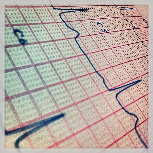 #ecg #ekg #electrocardiogram #medical #medicine #cardiology #heart #heartbeat #emergency #life #alive