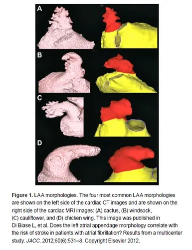 Figure 1 from Left Atrial Appendage Closure Devices published in Clinical Medicine Insights: Cardiology http://www.la-press.com/article.php?article_id=4251