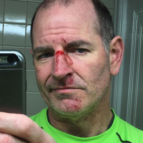 My fun #BikeDC adventure today: post cancer treatment... I hit a pothole and flip over onto my face. So much for my modeling career