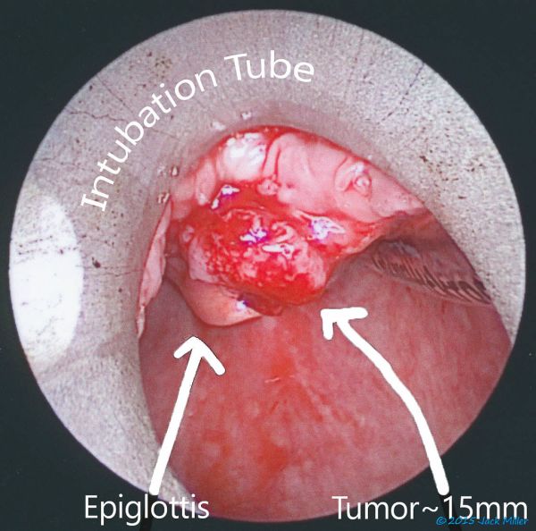 Cancer Treatment, July through August 2013