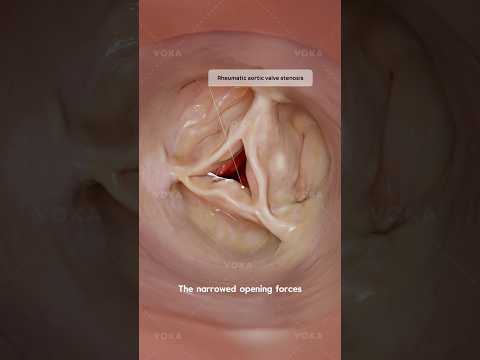 Rheumatic aortic valve stenosis: how it affects the heart. Explained in 3D by VOKA