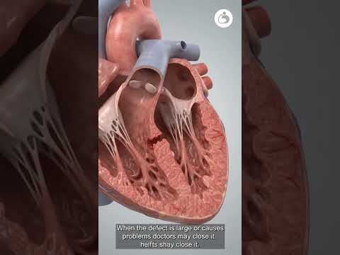 How Doctors Close a Hole in the Heart 🫀#ASD #HeartDefect #Cardiology #HeartProcedure #HealthFacts